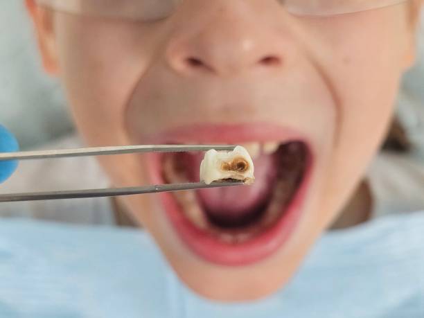Best Emergency Dental Extractions in Rainbow City, AL